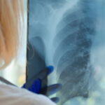 O que poucos falam sobre a tuberculose e por que isso preocupa o Brasil