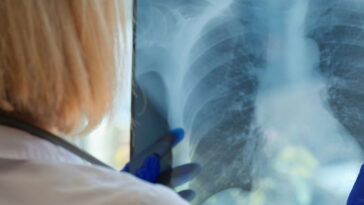 O que poucos falam sobre a tuberculose e por que isso preocupa o Brasil