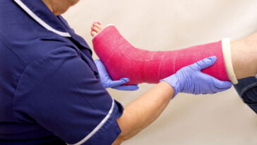 O erro mais comum após uma fratura que pode atrasar sua recuperação