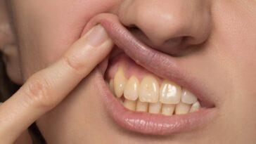 Quais alimentos mais mancham os dentes e como cuidar do esmalte de acordo com um dentista