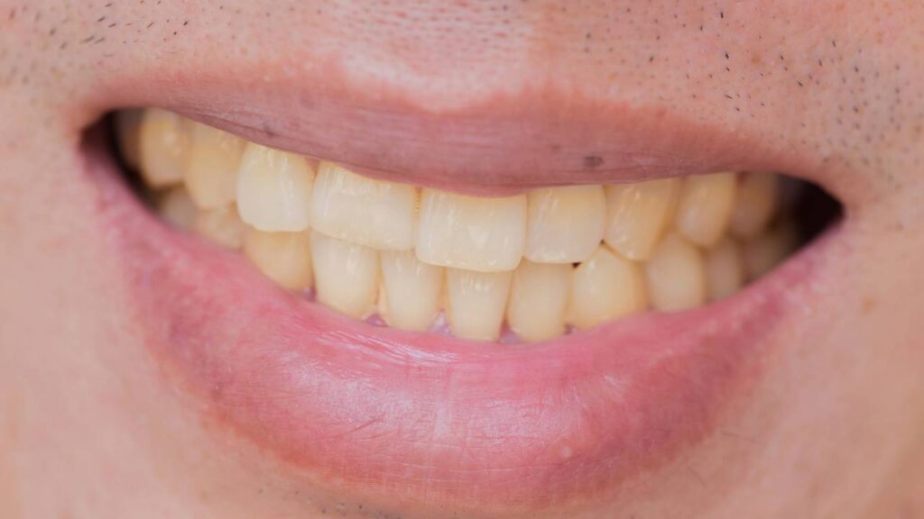 Quais alimentos mais mancham os dentes e como cuidar do esmalte de acordo com um dentista