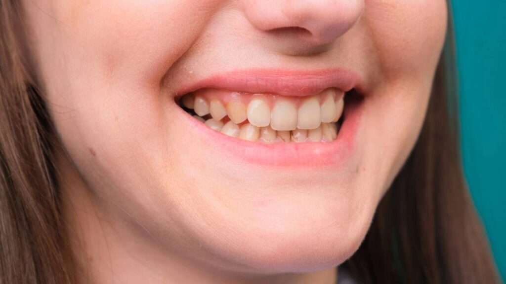 Quais alimentos mais mancham os dentes e como cuidar do esmalte de acordo com um dentista